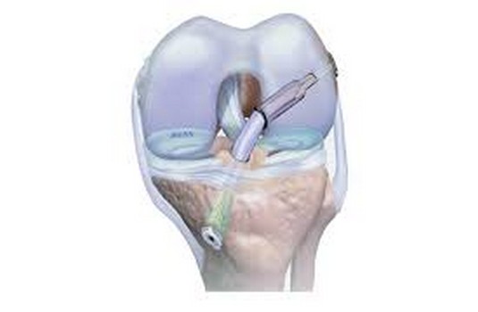 ACL (Anterior Cruciate Ligament) Reconstruction Surgery in